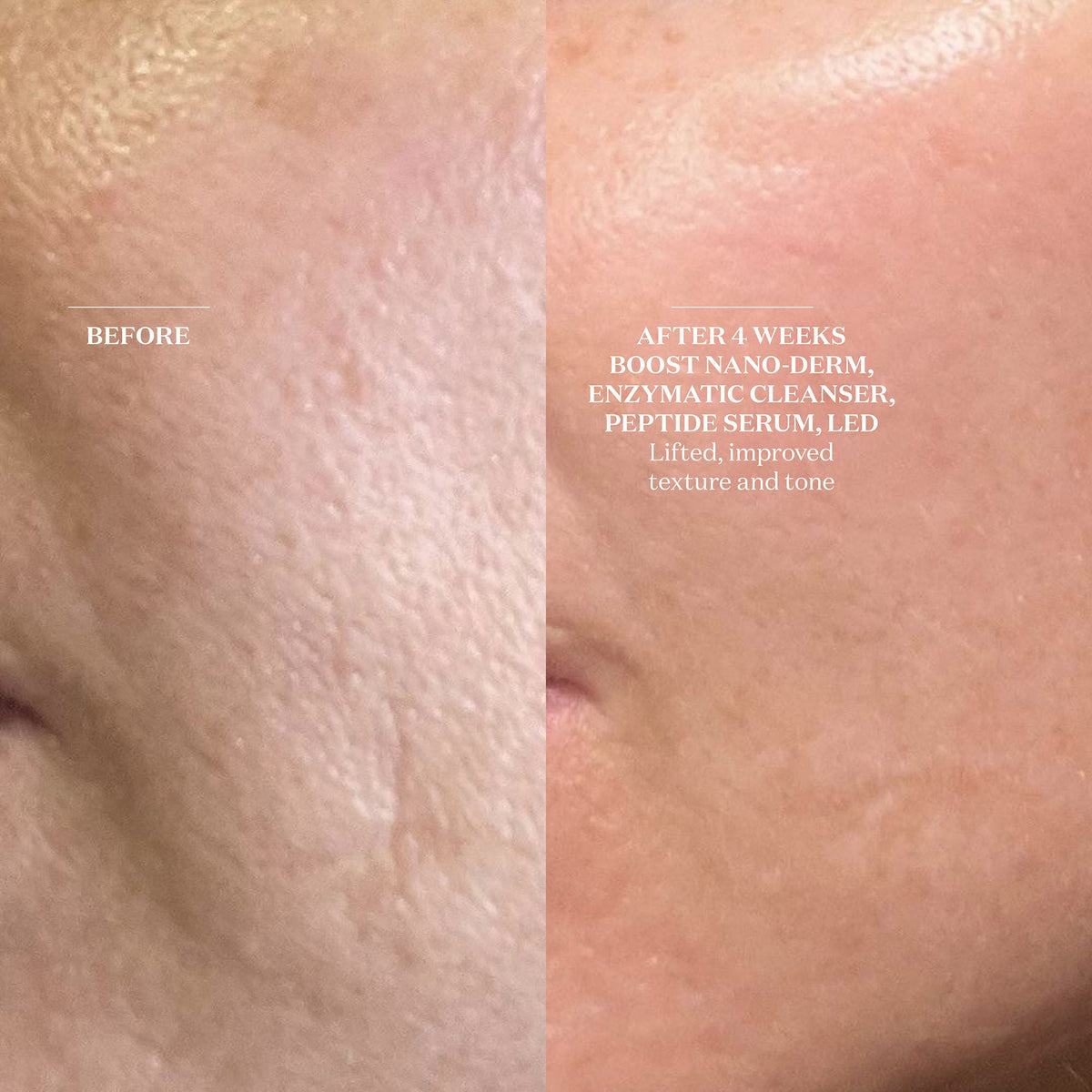 Boost Nano-Dermabrasion & Nano-Infusion Pen
