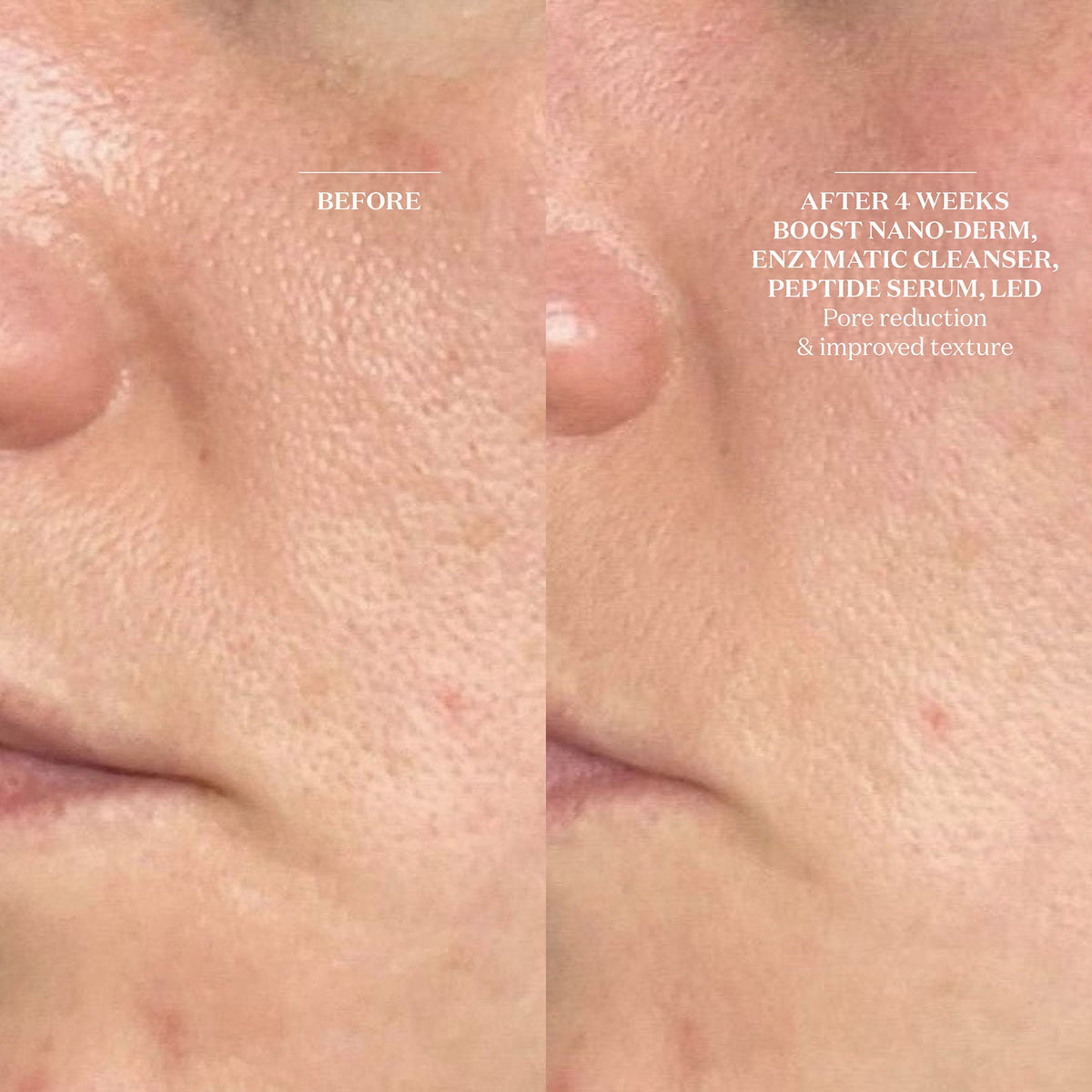 Boost Nano-Dermabrasion & Nano-Infusion Pen