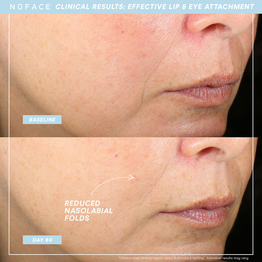Trinity+ and Effective Lip and Eye Attachment