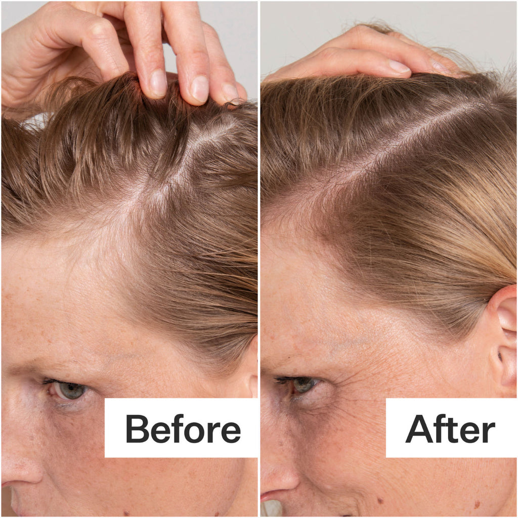 Salicylic Acid Scalp Exfoliator