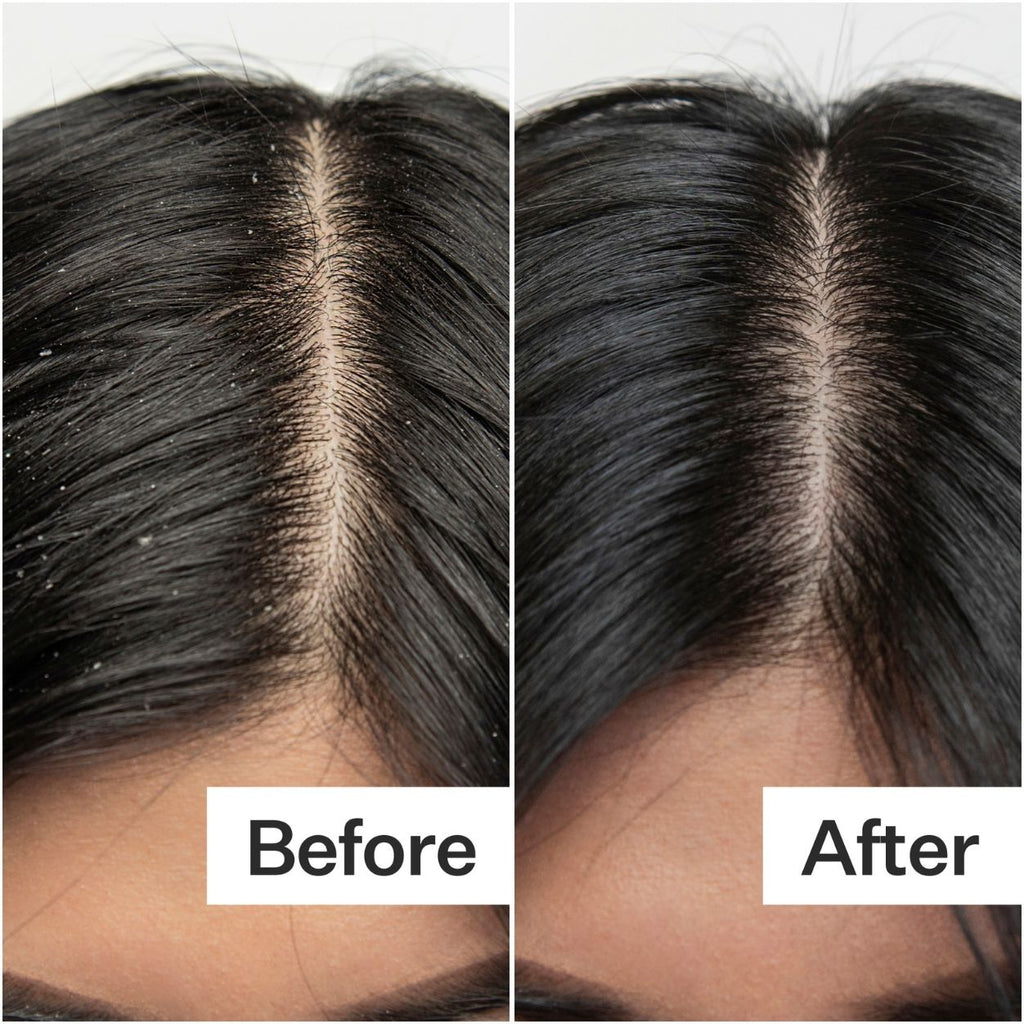Salicylic Acid Scalp Exfoliator