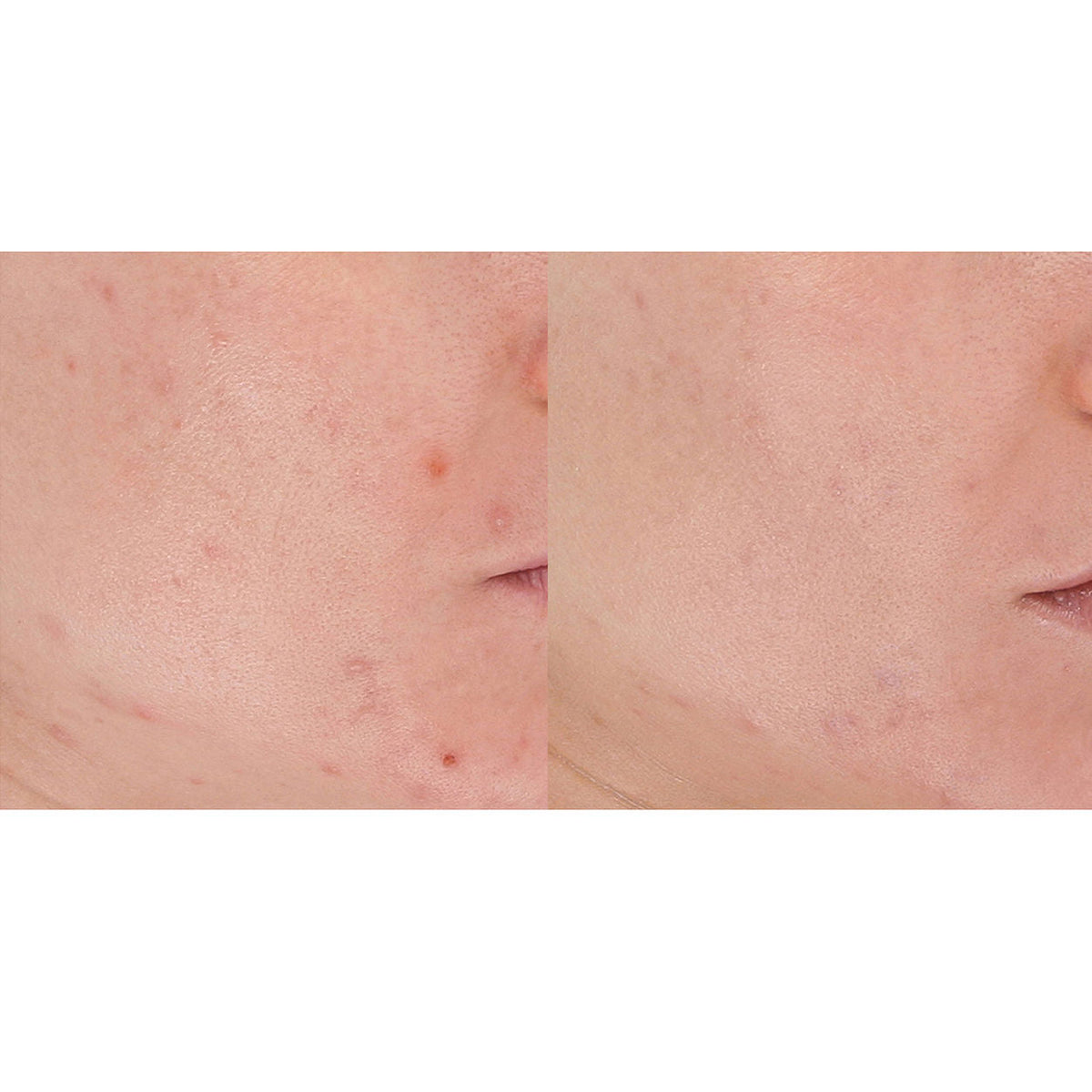 LightStim for Acne