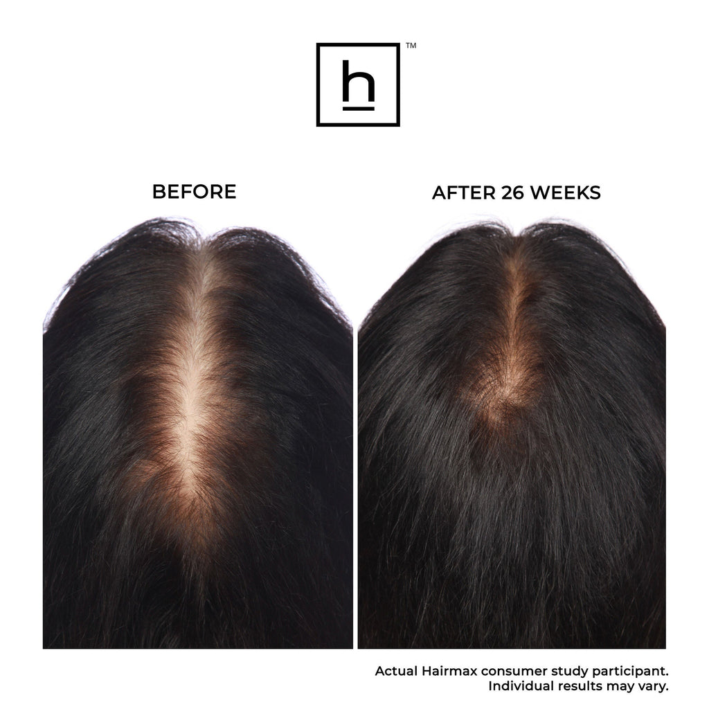 Ultima 12 Hair Growth LaserComb