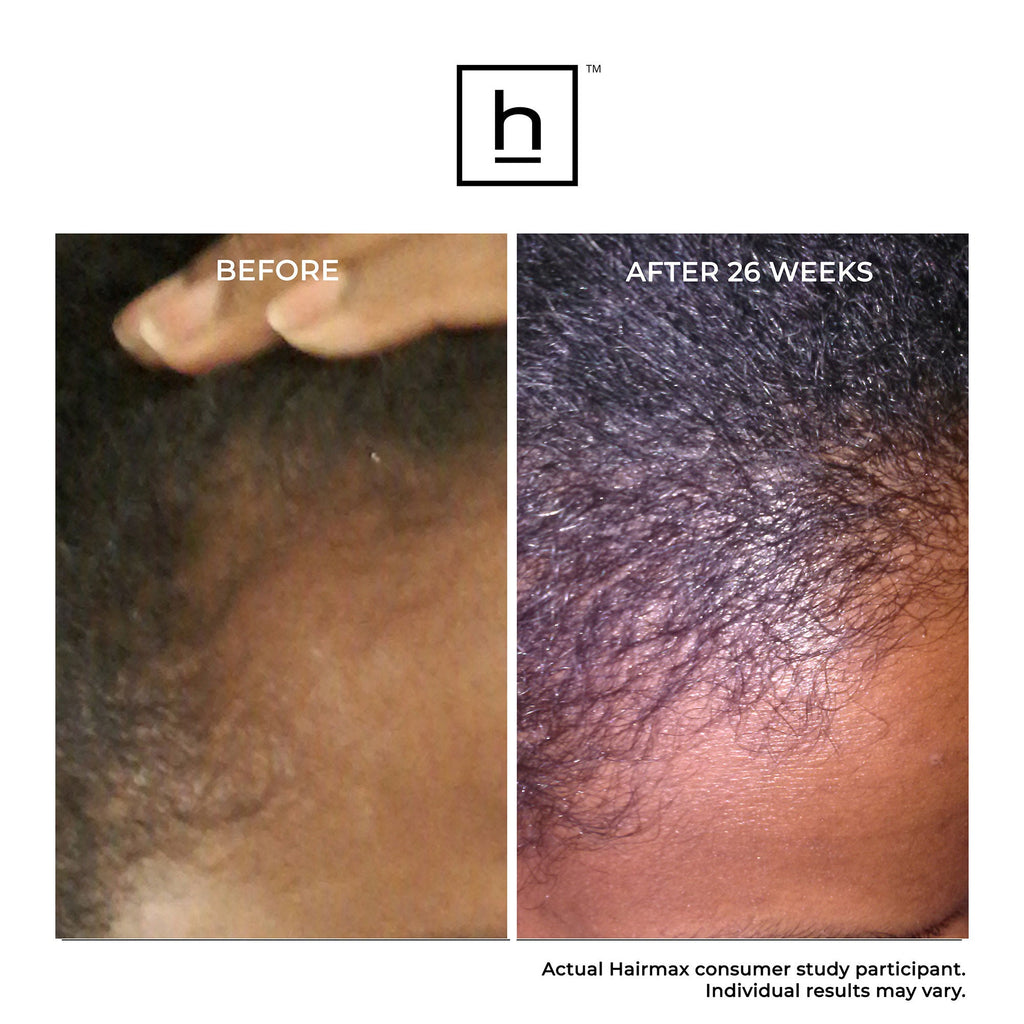 Ultima 12 Hair Growth LaserComb