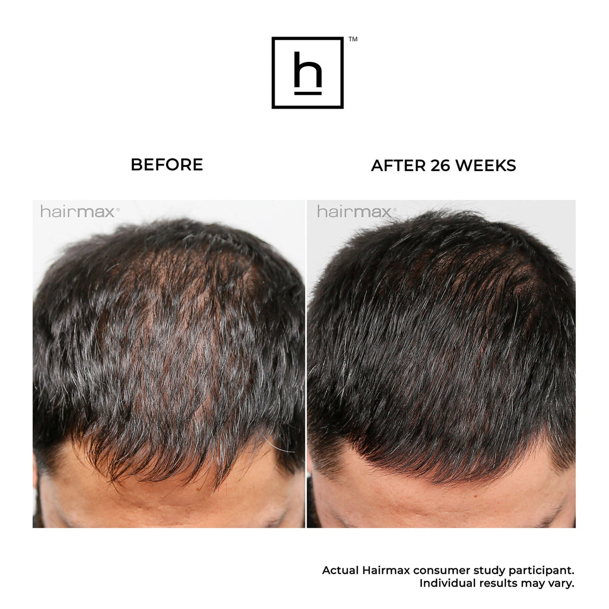 Ultima 12 Hair Growth LaserComb