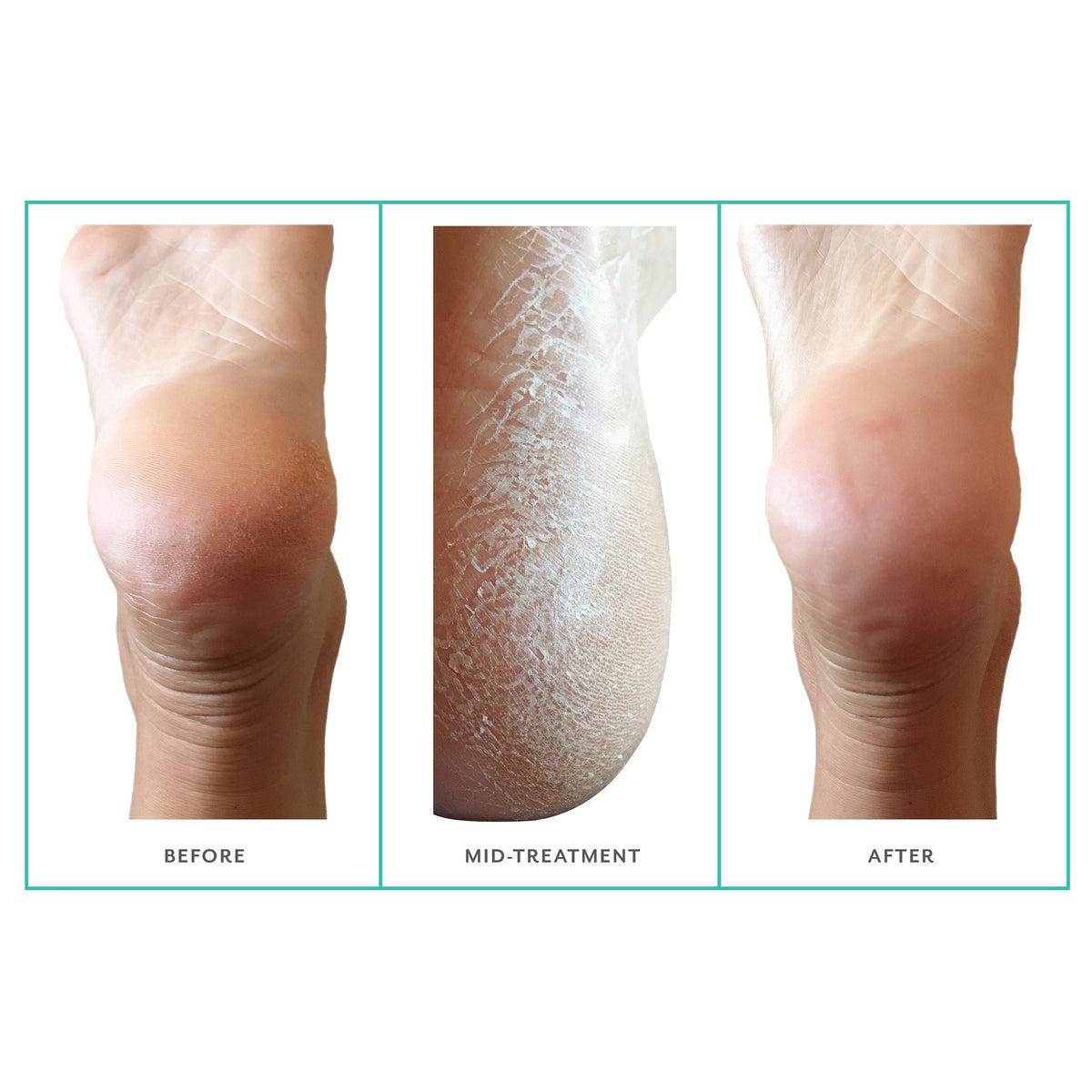 PoshPeel Pedi Cure