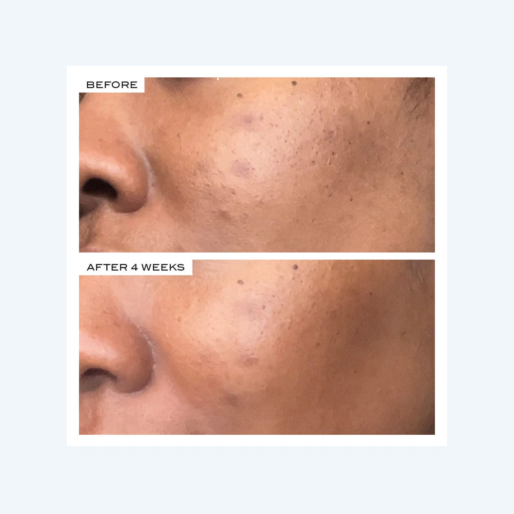 Precision Peel
