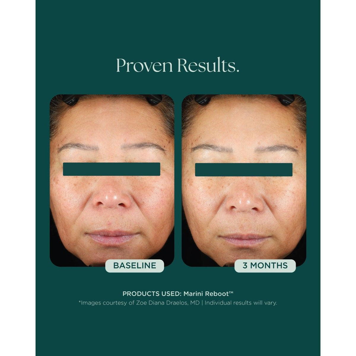 Marini Reboot™ PDRN Face Serum