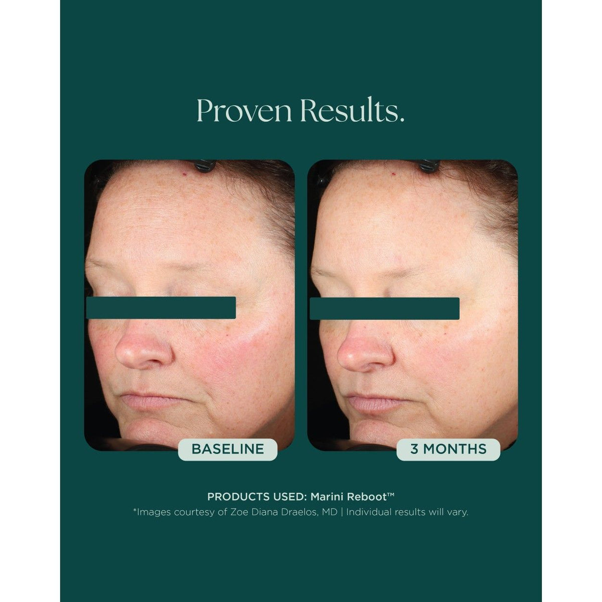 Marini Reboot™ PDRN Face Serum