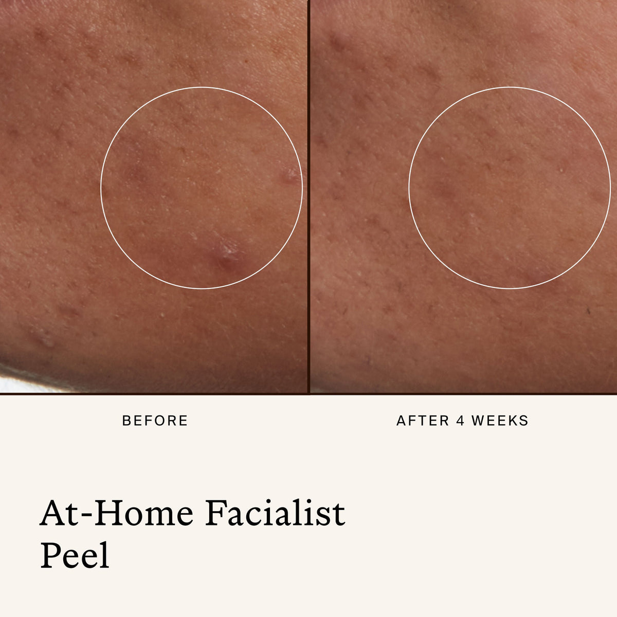 At-Home Facialist Peel